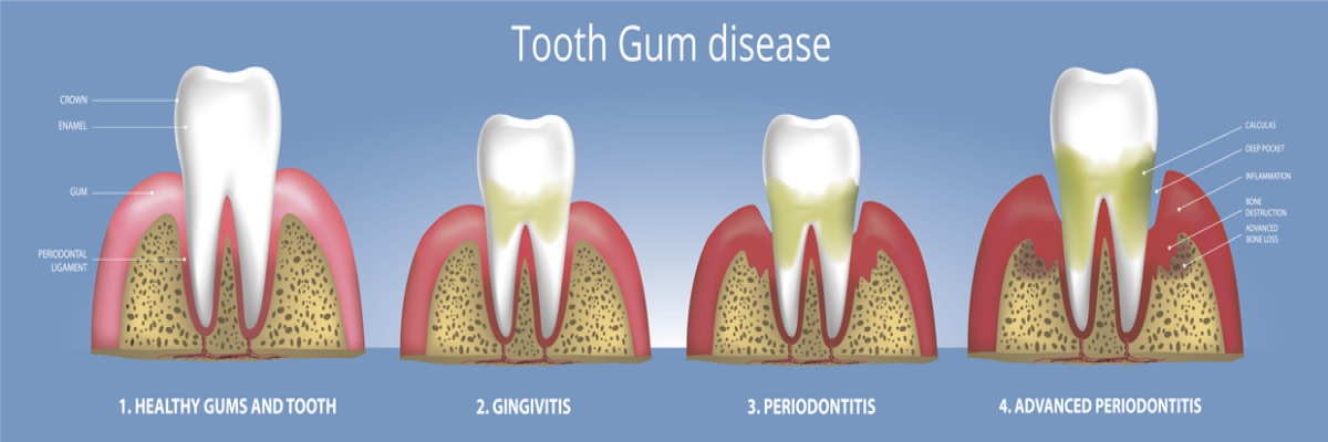 Gum recession | Modern methods of dental treatment | R-Dental