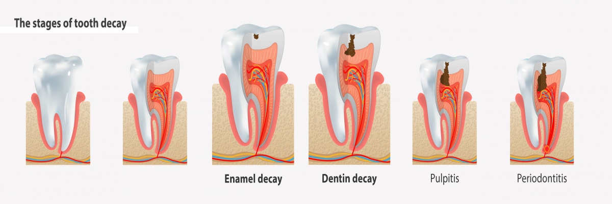Tooth decay treatment