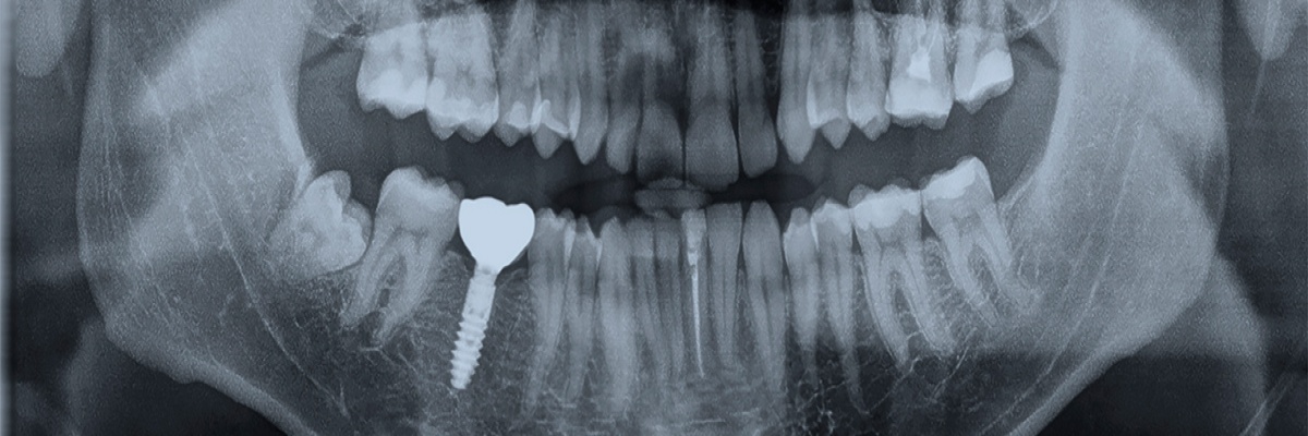 Tandimplantat | Renaissance Dental | Tandläkare