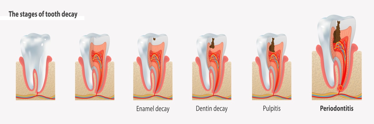 Periodontitis | Treatment | Renaissance Dental Stockholm