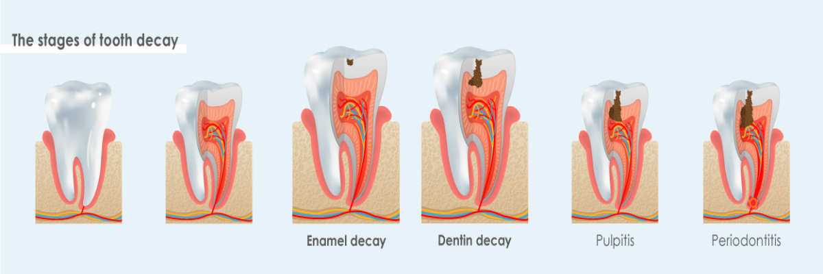 Pulpitis treatment | Renaissance Dental | Dentist Stockholm